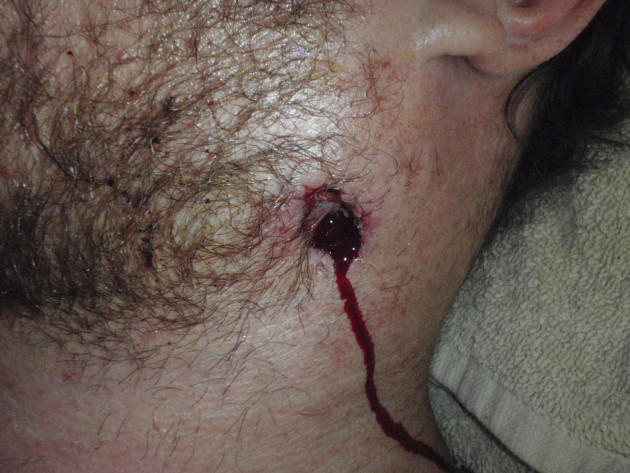 AK47 Neck Wound