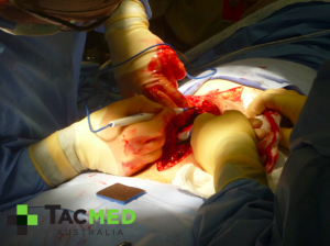 Gunshot wound laparotomy 1