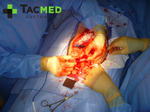 Gunshot wound laparotomy 2