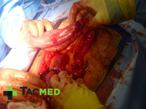 Gunshot wound laparotomy 3