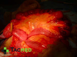Gunshot wound laparotomy 4