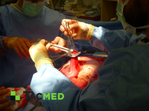 Gunshot wound laparotomy 5