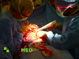 Gunshot wound laparotomy 6