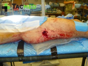 Gunshot wound leg 1