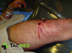 Gunshot wound leg 2