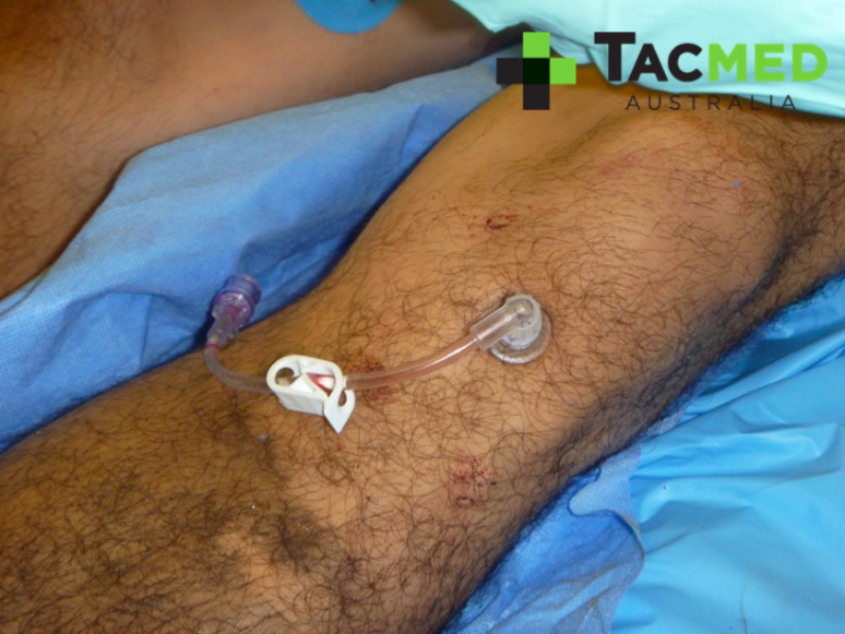 Intraosseous GSW casualty