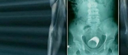 News: Al Qaeda Surgeon Implants Belly Bombs in Kids