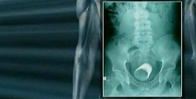 News: Al Qaeda Surgeon Implants Belly Bombs in Kids