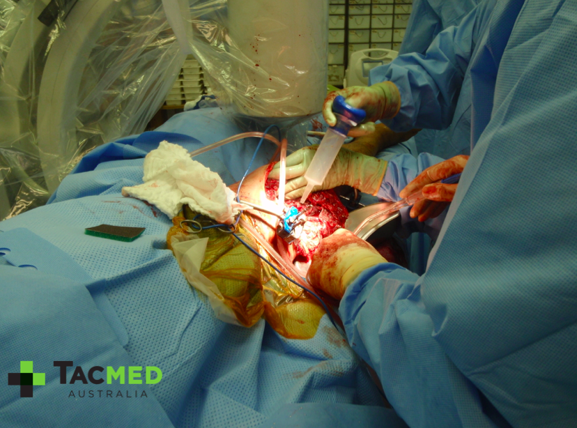 Gunshot leg exfix II