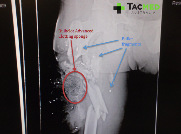 Gunshot leg xray 1