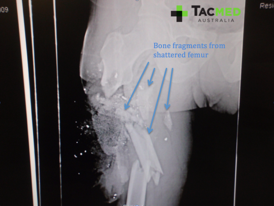 Gunshot leg xray 2