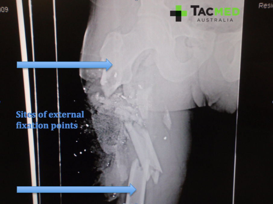 Gunshot leg xray 3