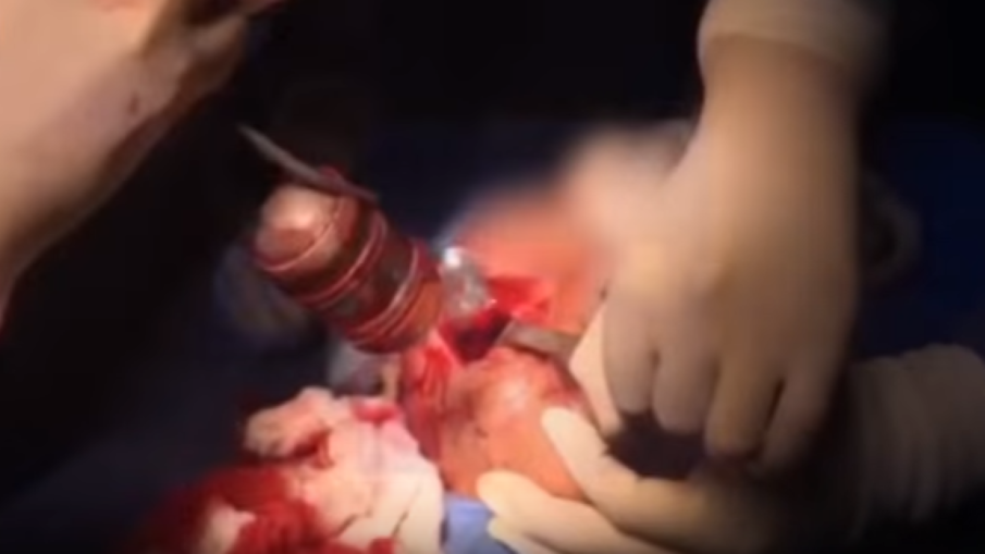 Watch: Surgeons remove live grenade from Colombian soldier’s face