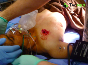 Gunshot wound chest 4