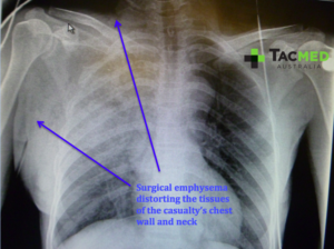 Gunshot wound chest X-ray