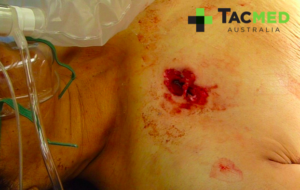 Gunshot wound chest exit wound