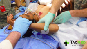 Positioning the casualty for chest tube insertion