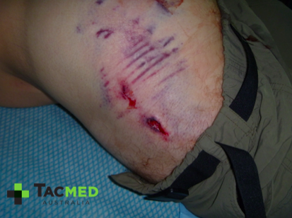 Gunshot wound day 2_2