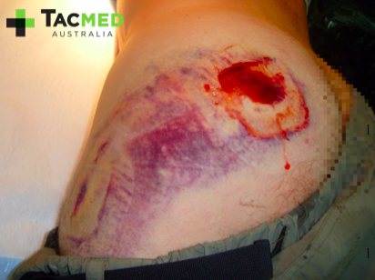 Gunshot wound day 4_2