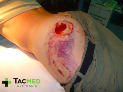 Gunshot wound day 7_2