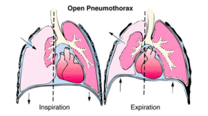 Open pneumothorax