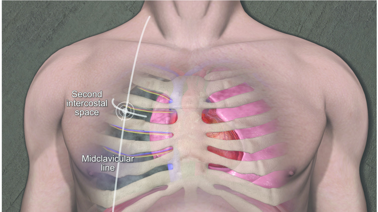 (WARNING: GRAPHIC IMAGES) Through-and-through Gunshot Wound To The ...