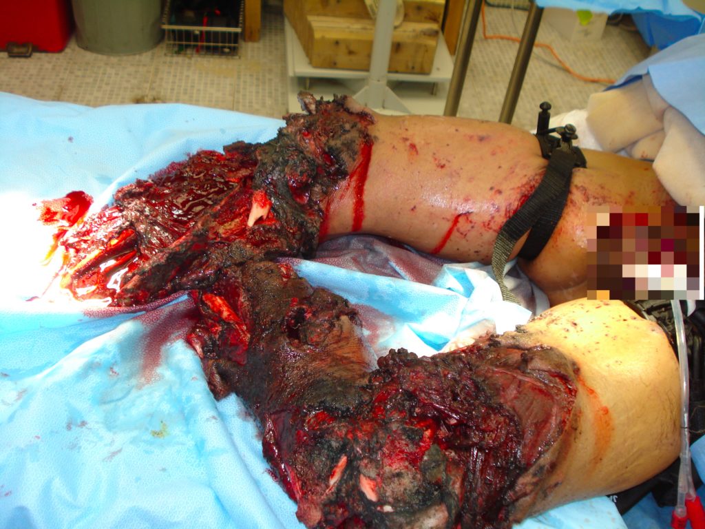 severe bilateral lower leg damage following IED strike with arterial tourniquets in place.