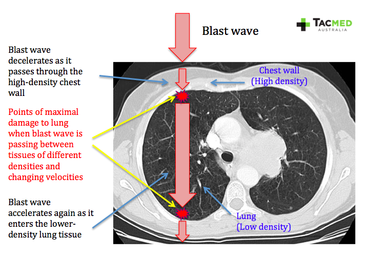 blast-wave-through-chest
