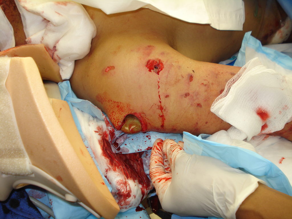 Stone imbedded in casualty's arm following IED blast