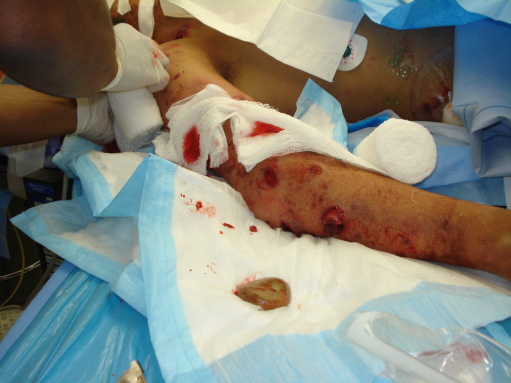 Stone imbedded in casualty's arm following IED blast