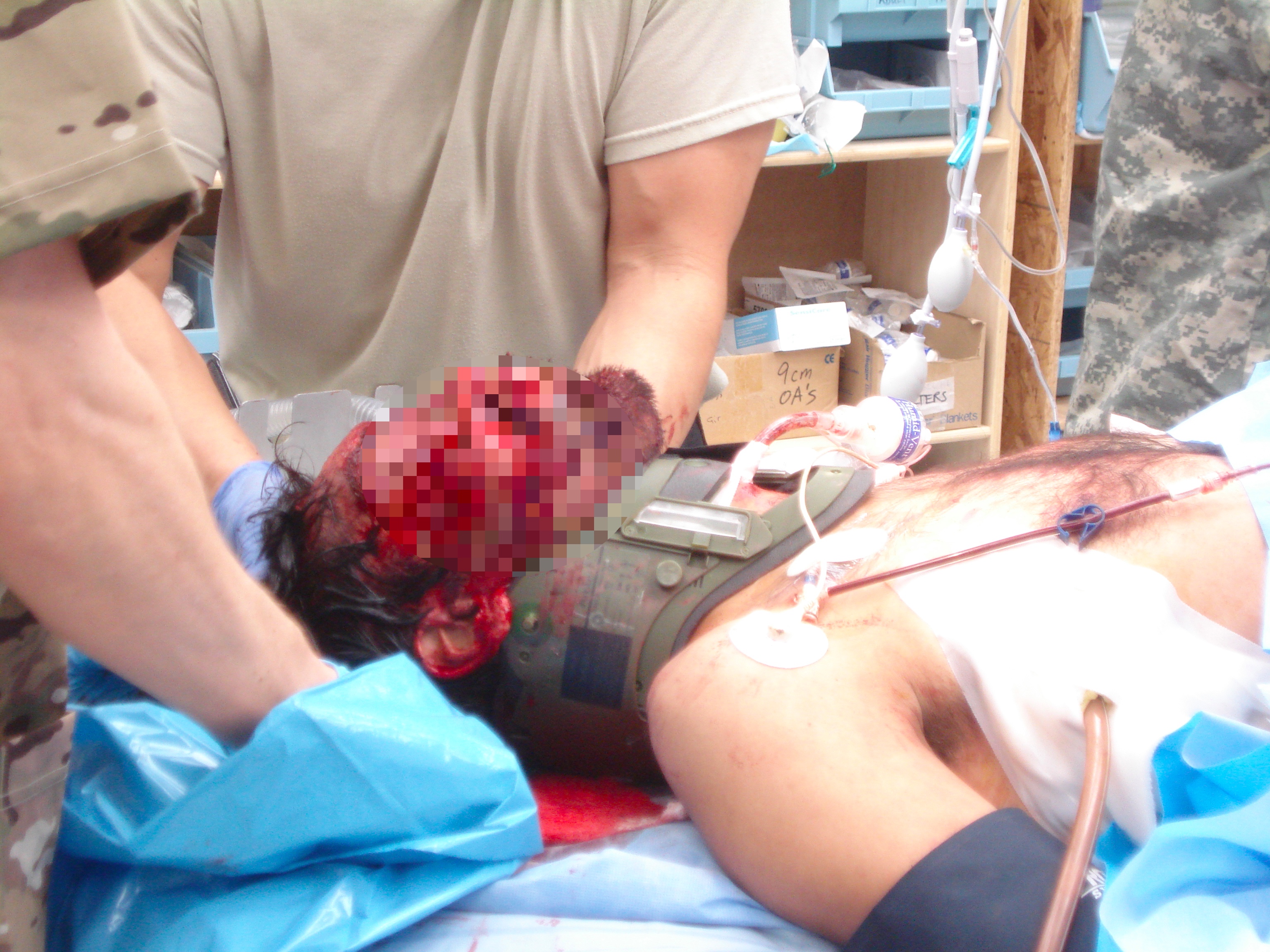 Facial burns and trauma in an IED casualty requiring surgical airway. Chest tube is also in place for penetrating chest injury.