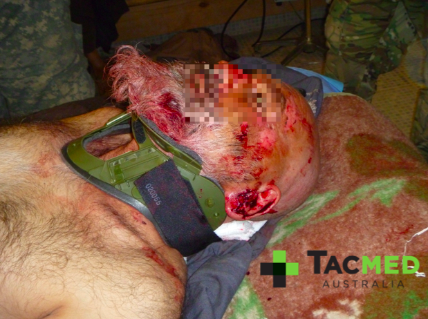 IED blast casualty bleeding from a ruptured left eardrum
