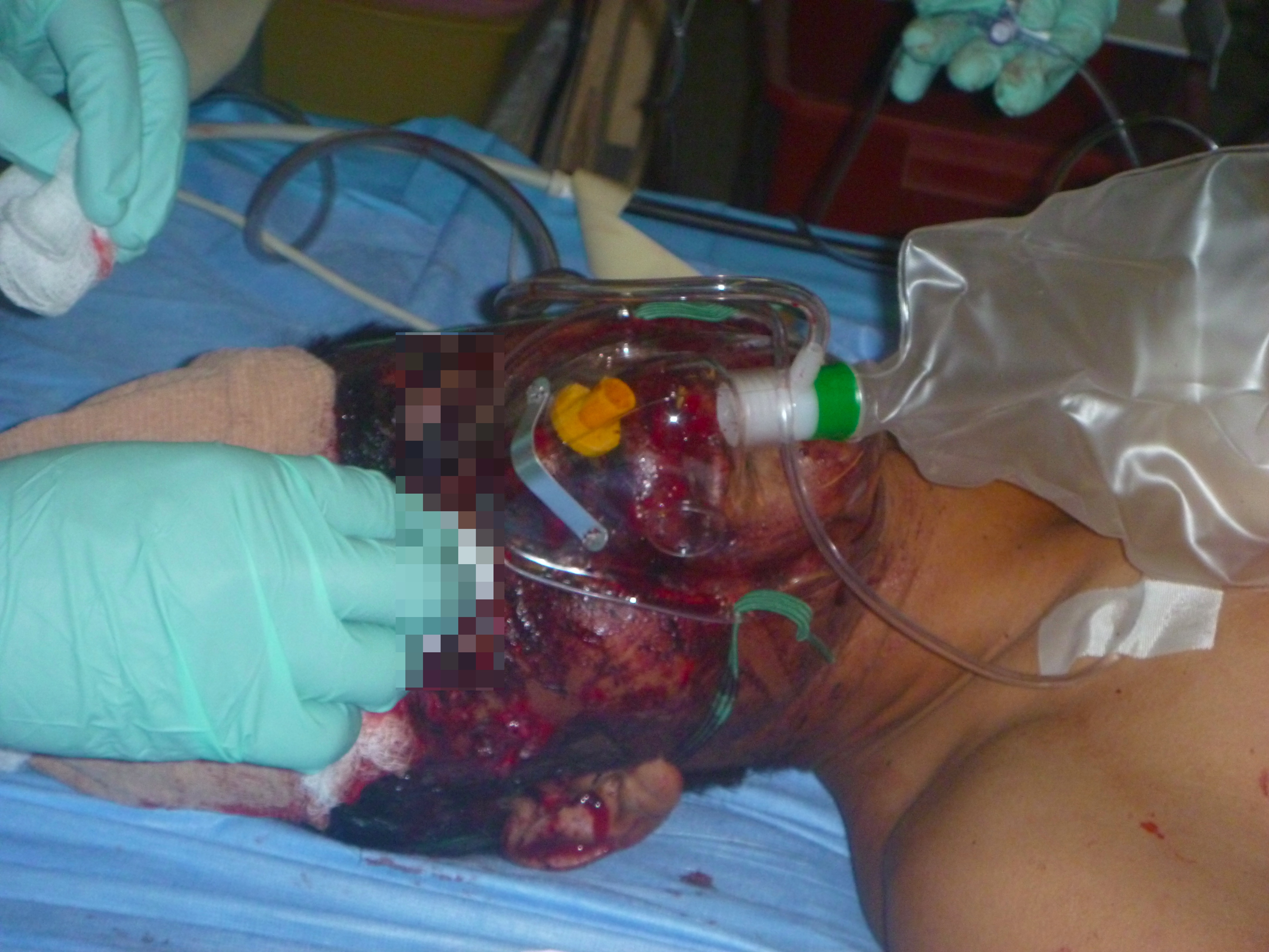 Severe facial burns in an IED casualty