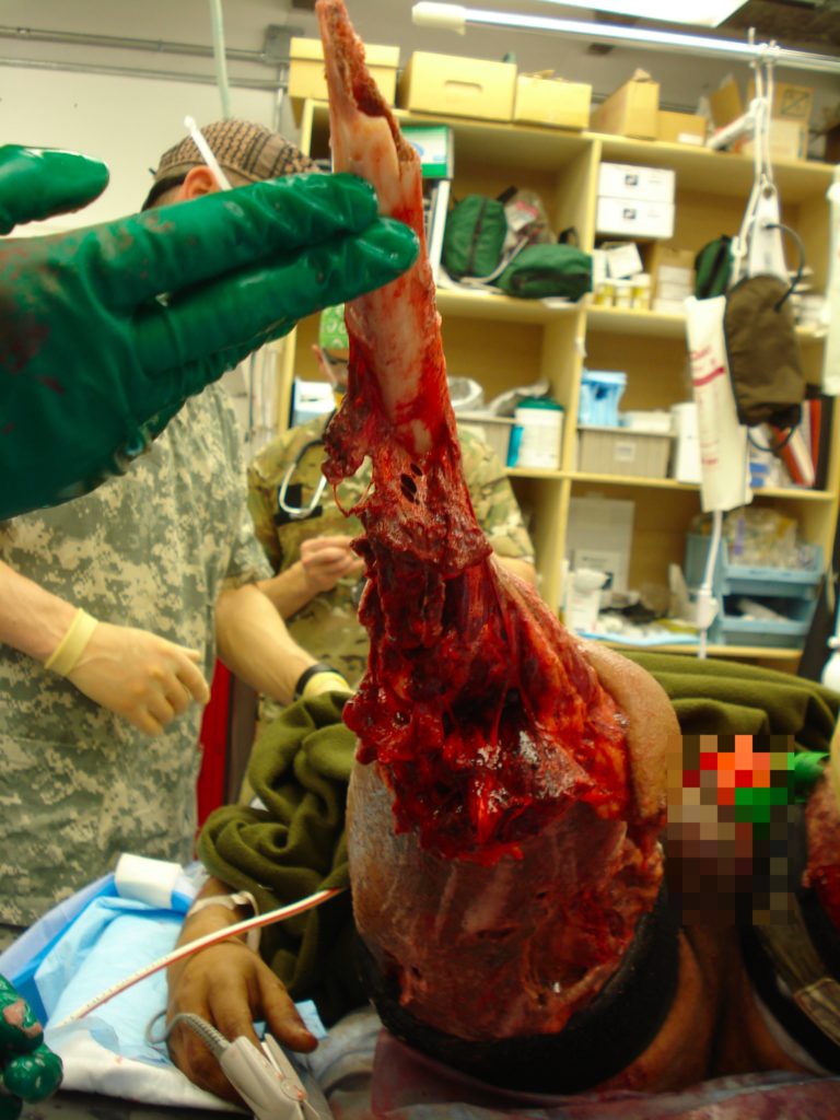 Lower limb IED traumatic amputation with arterial TQ in place