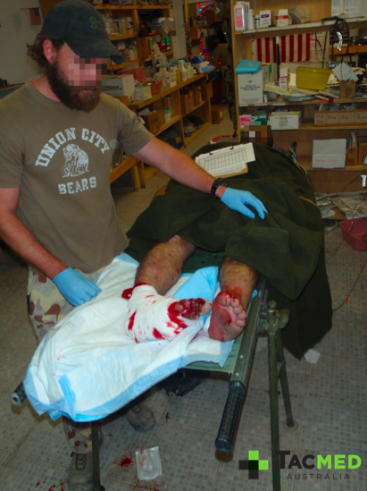 Assessing lower limb injuries of a casualty from an IED blast in an unarmored vehicle.