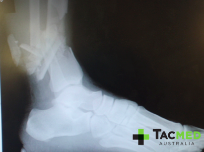 Severe lower limb fractures in a casualty from a vehicle IED strike