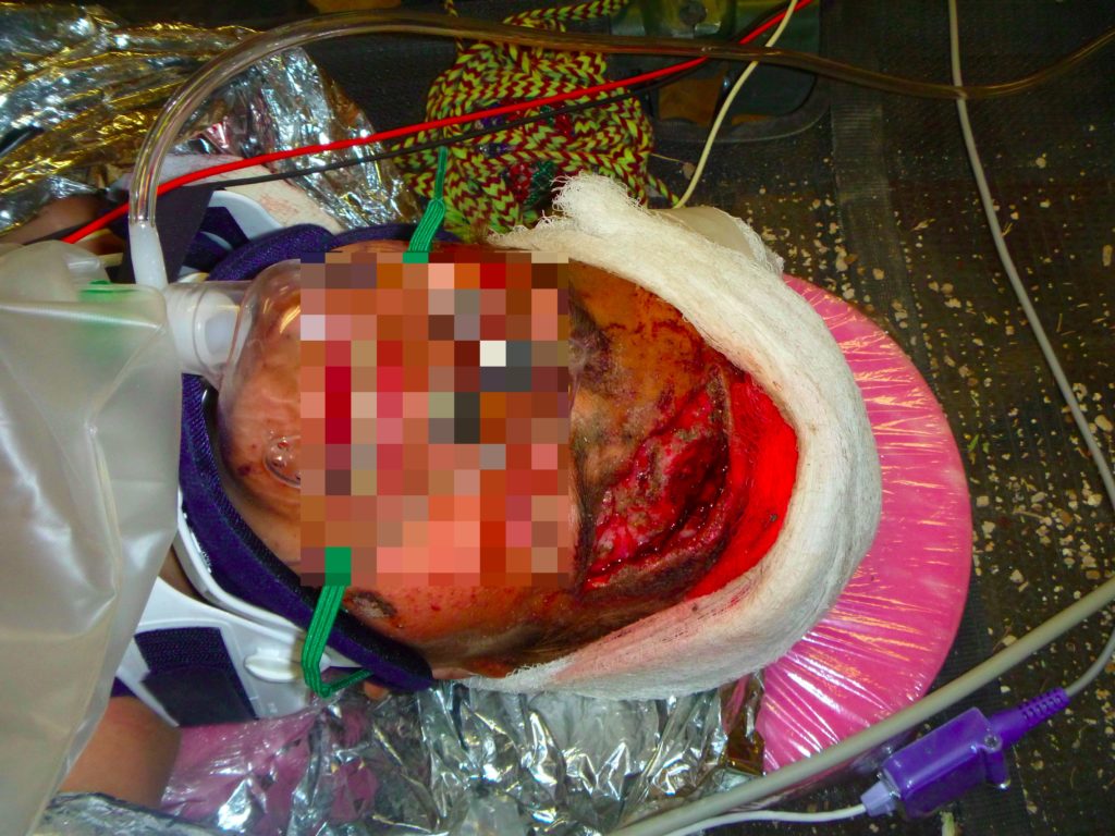 Open skull fracture in an IED blast casualty