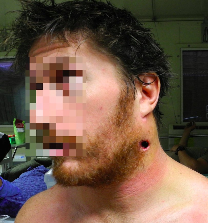 A bullet to the neck couldn’t stop him