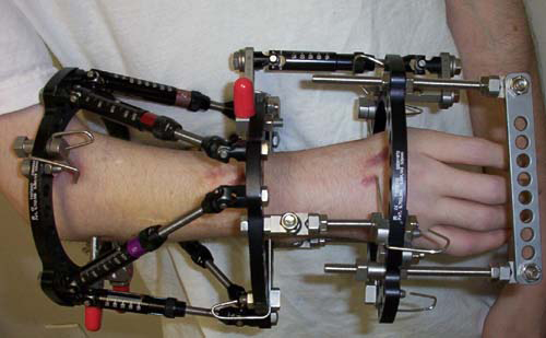 support for a broken wrist and arm