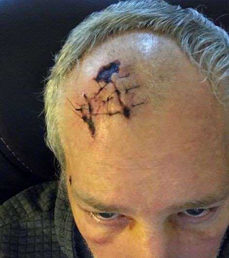 Don's head wound