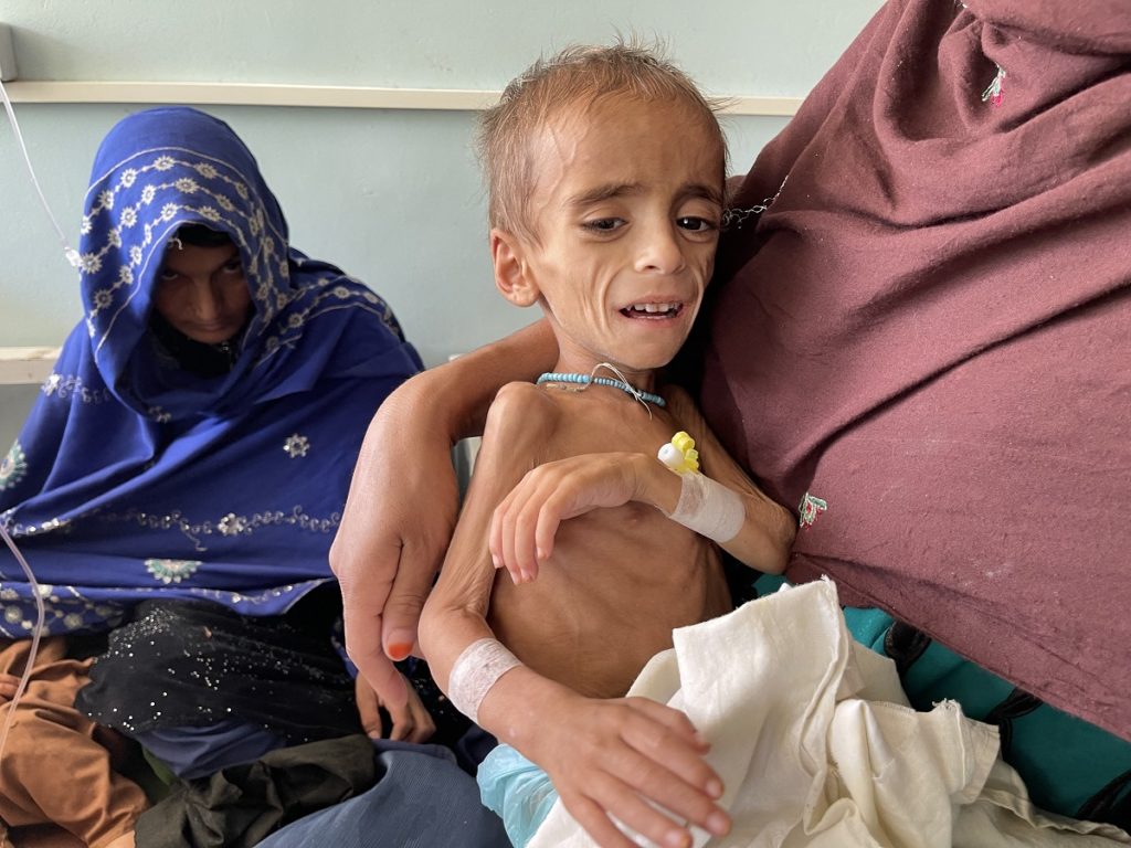 A malnourished Afghan child is treated at a hospital in Kandahar (AFP via Asia Times). Source: https://asiatimes.com/2022/01/rich-western-countries-stand-by-as-afghans-face-starvation/